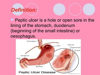 Definition:
Peptic ulcer is a hole or open sore in the
lining of the stomach, duodenum
(beginning of the small intestine) or
oesophagus.
 