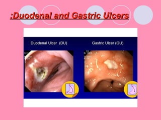 Duodenal and Gastric UlcersDuodenal and Gastric Ulcers::
 