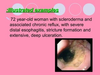 72 year-old woman with scleroderma and
associated chronic reflux, with severe
distal esophagitis, stricture formation and
extensive, deep ulceration.
Illustrated examplesIllustrated examples::
 