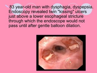 83 year-old man with dysphagia, dyspepsia.
Endoscopy revealed twin "kissing" ulcers
just above a lower esophageal stricture
through which the endoscope would not
pass until after gentle balloon dilation.
 