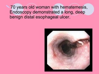 70 years old woman with hematemesis,
Endoscopy demonstrated a long, deep
benign distal esophageal ulcer.
 