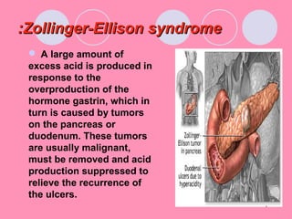 Zollinger-Ellison syndromeZollinger-Ellison syndrome::
 A large amount of
excess acid is produced in
response to the
overproduction of the
hormone gastrin, which in
turn is caused by tumors
on the pancreas or
duodenum. These tumors
are usually malignant,
must be removed and acid
production suppressed to
relieve the recurrence of
the ulcers.
 