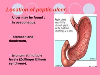 Location of peptic ulcer:
Ulcer may be found :
In oesophagus,
 stomach and
duodenum,
jejunum at multiple
levels (Zollinger Ellison
syndrome).
 