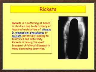 Rickets
Rickets is a softening of bones
in children due to deficiency or
impaired metabolism of vitamin
D, magnesium, phosphorus or
calcium, potentially leading to
fractures and deformity.
Rickets is among the most
frequent childhood diseases in
many developing countries.
 