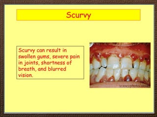 Scurvy
Scurvy can result in
swollen gums, severe pain
in joints, shortness of
breath, and blurred
vision.
 