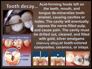 Tooth decay… Acid-forming foods left on
the teeth, mouth, and
tongue de-mineralize tooth
enamel, causing cavities or
holes. The cavity will eventually
expose the nerve-filled pulp,
and cause pain. The cavity must
be drilled out, cleaned, and filled
with gold, silver amalgams
(mercury alloy),or tooth-colored
composites, ceramics, or inlays.
 