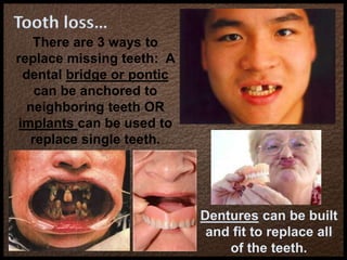 Tooth loss…
There are 3 ways to
replace missing teeth: A
dental bridge or pontic
can be anchored to
neighboring teeth OR
implants can be used to
replace single teeth.
Dentures can be built
and fit to replace all
of the teeth.
 