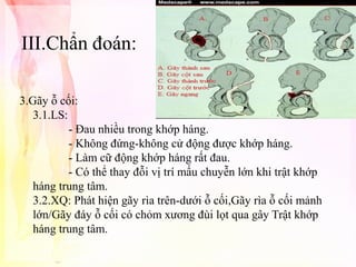 III.Chẩn đoán:
3.Gãy ỗ cối:
3.1.LS:
- Đau nhiều trong khớp háng.
- Không đứng-không cử động được khớp háng.
- Làm cữ động khớp háng rất đau.
- Có thể thay đỗi vị trí mấu chuyễn lớn khi trật khớp
háng trung tâm.
3.2.XQ: Phát hiện gãy rìa trên-dưới ỗ cối,Gãy rìa ỗ cối mảnh
lớn/Gãy đáy ỗ cối có chỏm xương đùi lọt qua gây Trật khớp
háng trung tâm.

 