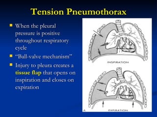 Tension Pneumothorax When the pleural pressure is positive throughout respiratory cycle  “ Ball-valve mechanism” Injury to pleura creates a  tissue flap  that opens on inspiration and closes on expiration 