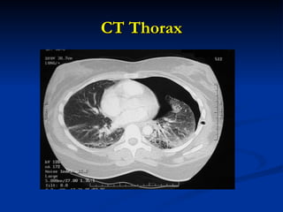 CT Thorax 