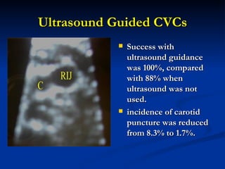 Ultrasound Guided CVCs Success with ultrasound guidance was 100%, compared with 88% when ultrasound was not used.  incidence of carotid puncture was reduced from 8.3% to 1.7%. 