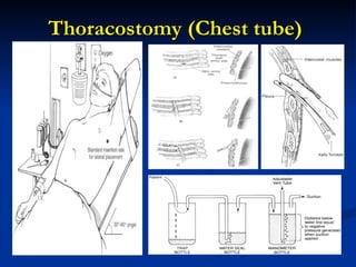 Thoracostomy (Chest tube)  