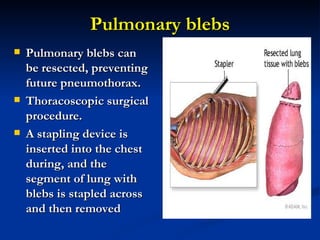 Pulmonary blebs Pulmonary blebs can be resected, preventing future pneumothorax.  Thoracoscopic surgical procedure.  A stapling device is inserted into the chest during, and the segment of lung with blebs is stapled across and then removed 