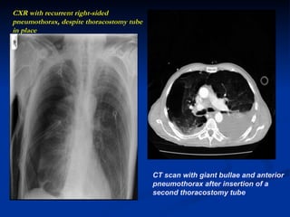 CXR with recurrent right-sided pneumothorax, despite thoracostomy tube in place CT scan with giant bullae and anterior pneumothorax after insertion of a second thoracostomy tube   