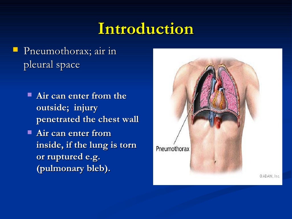 pneumothorax in ICU