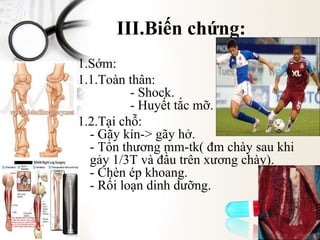 III.Biến chứng:
1.Sớm:
1.1.Toàn thân:
- Shock.
- Huyết tắc mỡ.
1.2.Tại chỗ:
- Gãy kín-> gãy hở.
- Tổn thương mm-tk( đm chày sau khi
gảy 1/3T và đầu trên xương chày).
- Chèn ép khoang.
- Rối loạn dinh dưỡng.

 