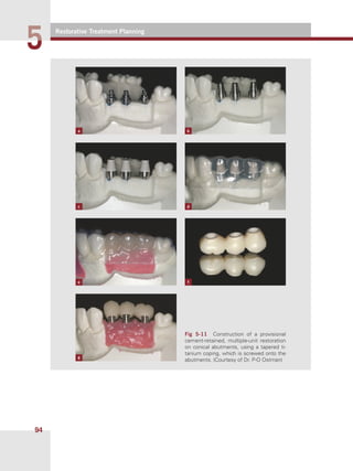 Restorative Treatment Planning
55
94
Fig  5-11    Construction of a provisional
cement-retained, multiple-unit restoration
on conical abutments, using a tapered ti-
tanium coping, which is screwed onto the
abutments. (Courtesy of Dr. P-O Ostman)
a b
dc
g
e f
 