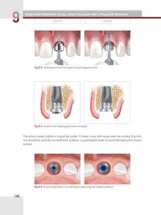 Single-tooth Restoration Using a Direct Technique with a Preparable Abutment
99
146
external internal
The entire implant platform should be visible. If there is any soft tissue over the surface (Fig 9-4),
this should be carefully removed with a plastic- or gold-tipped scaler to avoid damaging the implant
surface.
Fig 9-3  Implant with healing abutment removed.
Fig 9-4  Ensure that there is no soft tissue obscuring the implant platform.
Fig 9-2  Healing abutment removed using hexagonal driver.
 