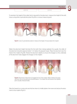 Procedure
99
147
external internal
To ascertain the height of the collar that is required for the abutment, measure the height of the soft
tissue using either a periodontal probe (Fig 9-5) or a tissue measuring post.
Select the abutment height that best fits the tooth that is being replaced. As a guide, the collar of
the abutment should lie approximately 1 mm below the gingival margin. Place the abutment over the
head of the implant (Fig 9-6). Rotate the abutment slightly to ensure the hexagon on the underside
of the abutment fully engages the hexagon of the implant.
Take the hexed try-in screw and use the hex driver to initially tighten the screw and secure the abut-
ment to the implant (Fig 9-7).
Fig 9-5  Use of a periodontal probe to measure the height of tissue above the implant.
Fig 9-6  Placement of abutment to engage the hex of the implant.When seated, the prepa-
red finish line on the abutment should be about 1 mm below the soft tissue at the highest
point (usually interproximally).
 