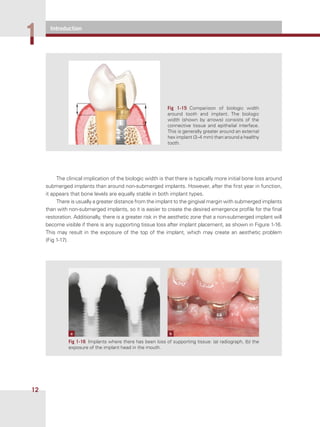 Introduction
11
12
The clinical implication of the biologic width is that there is typically more initial bone loss around
submerged implants than around non-submerged implants. However, after the ﬁrst year in function,
it appears that bone levels are equally stable in both implant types.
There is usually a greater distance from the implant to the gingival margin with submerged implants
than with non-submerged implants, so it is easier to create the desired emergence proﬁle for the ﬁnal
restoration. Additionally, there is a greater risk in the aesthetic zone that a non-submerged implant will
become visible if there is any supporting tissue loss after implant placement, as shown in Figure 1-16.
This may result in the exposure of the top of the implant, which may create an aesthetic problem
(Fig 1-17).
Fig  1-15 Comparison of biologic width
around tooth and implant. The biologic
width (shown by arrows) consists of the
connective tissue and epithelial interface.
This is generally greater around an external
hex implant (3–4 mm) than around a healthy
tooth.
Fig 1-16 Implants where there has been loss of supporting tissue: (a) radiograph, (b) the
exposure of the implant head in the mouth.
a b
 