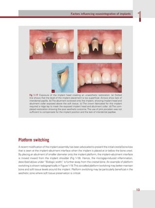 Factors inﬂuencing osseointegration of implants
11
13
Platform switching
A recent modiﬁcation of the implant assembly has been advocated to prevent the initial crestal bone loss
that is seen at the implant–abutment interface when the implant is placed at or below the bone crest.
By placing an abutment of smaller diameter onto the implant platform, the implant–abutment interface
is moved inward from the implant shoulder (Fig 1-18). Hence, the microgap-induced inﬂammation,
described above under “Biologic width,” is further away from the crestal bone. An example of platform
switching is shown radiographically in Figure 1-19.This so-called platform switching may better maintain
bone and soft tissue levels around the implant. Platform switching may be particularly beneﬁcial in the
aesthetic zone where soft tissue preservation is critical.
Fig  1-17 Exposure of the implant head creating an unaesthetic restoration. (a) Dotted
line shows that the level of the implant placement is too superﬁcial. Arrows show lack of
interdental papilla. (b)The abutment screwed onto the implant, showing implant head and
abutment collar exposed above the soft tissue. (c) The crown fabricated for this implant
required a ridge lap to mask the exposed implant head and abutment collar. (d) The com-
pleted restoration showing the poor aesthetic outcome.The use of pink porcelain was not
sufﬁcient to compensate for the implant position and the lack of interdental papillae.
a b
dc
 