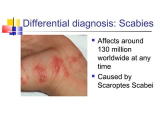 Differential diagnosis: Scabies
 Affects around
130 million
worldwide at any
time
 Caused by
Scaroptes Scabei
 