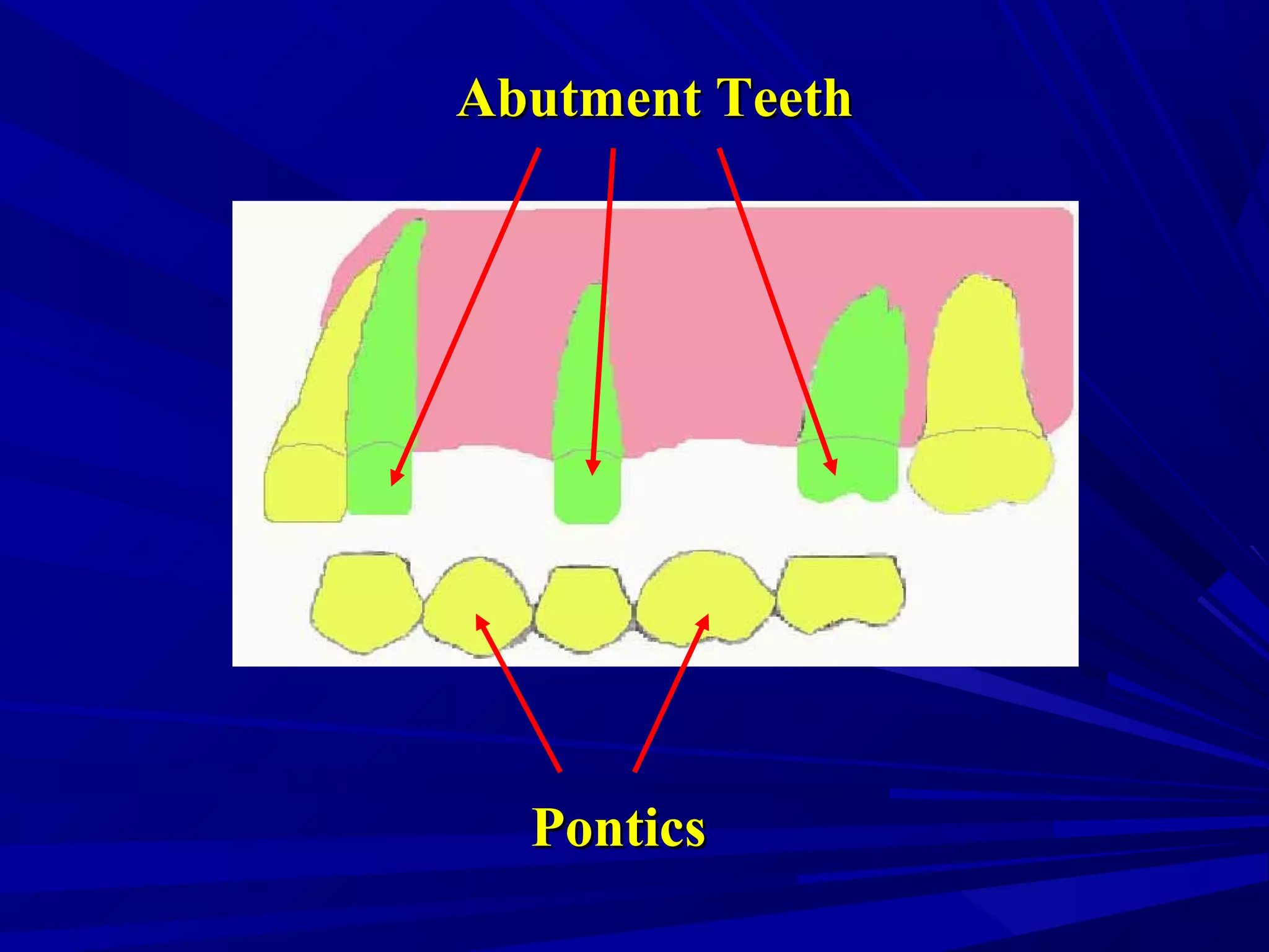 Abutment TeethAbutment Teeth
PonticsPontics
 