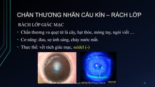 CHẤN THƯƠNG NHÃN CẦU KÍN – RÁCH LỚP
RÁCH LỚP GIÁC MẠC
• Chấn thương va quẹt từ lá cây, hạt thóc, móng tay, ngòi viết …
• Cơ năng: đau, sợ ánh sáng, chảy nước mắt.
• Thực thể: vết rách giác mạc, seidel (-)
ThS.BS. Trần Đình Minh Huy - Bộ môn Mắt Đại Học Y Dược TP.HCM 25
 