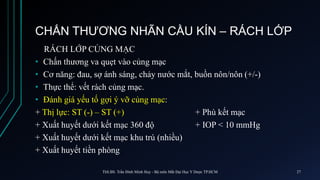 CHẤN THƯƠNG NHÃN CẦU KÍN – RÁCH LỚP
RÁCH LỚP CỦNG MẠC
• Chấn thương va quẹt vào củng mạc
• Cơ năng: đau, sợ ánh sáng, chảy nước mắt, buồn nôn/nôn (+/-)
• Thực thể: vết rách củng mạc.
• Đánh giá yếu tố gợi ý vỡ củng mạc:
+ Thị lực: ST (-) – ST (+) + Phù kết mạc
+ Xuất huyết dưới kết mạc 360 độ + IOP < 10 mmHg
+ Xuất huyết dưới kết mạc khu trú (nhiều)
+ Xuất huyết tiền phòng
ThS.BS. Trần Đình Minh Huy - Bộ môn Mắt Đại Học Y Dược TP.HCM 27
 