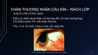 CHẤN THƯƠNG NHÃN CẦU KÍN – RÁCH LỚP
RÁCH LỚP CỦNG MẠC
• Điều trị: phẫu thuật khâu vết thương đối với mọi trường hợp.
Chỉ khâu nylon 9-0, silk hoặc Dacron.
• Tùy vị trí vết rách: càng ra sau, chỉ càng lớn
ThS.BS. Trần Đình Minh Huy - Bộ môn Mắt Đại Học Y Dược TP.HCM 28
 