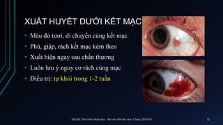 XUẤT HUYẾT DƯỚI KẾT MẠC
• Màu đỏ tươi, di chuyển cùng kết mạc.
• Phù, giập, rách kết mạc kèm theo
• Xuất hiện ngay sau chấn thương
• Luôn lưu ý nguy cơ rách củng mạc
• Điều trị: tự khỏi trong 1-2 tuần
ThS.BS. Trần Đình Minh Huy - Bộ môn Mắt Đại Học Y Dược TP.HCM 32
 
