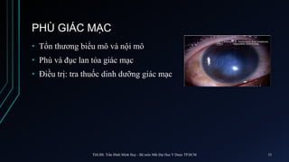PHÙ GIÁC MẠC
• Tổn thương biểu mô và nội mô
• Phù và đục lan tỏa giác mạc
• Điều trị: tra thuốc dinh dưỡng giác mạc
ThS.BS. Trần Đình Minh Huy - Bộ môn Mắt Đại Học Y Dược TP.HCM 33
 