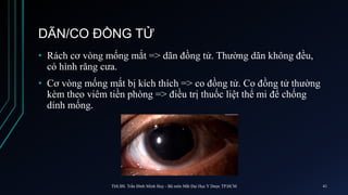 DÃN/CO ĐỒNG TỬ
• Rách cơ vòng mống mắt => dãn đồng tử. Thường dãn không đều,
có hình răng cưa.
• Cơ vòng mống mắt bị kích thích => co đồng tử. Co đồng tử thường
kèm theo viêm tiền phòng => điều trị thuốc liệt thể mi để chống
dính mống.
ThS.BS. Trần Đình Minh Huy - Bộ môn Mắt Đại Học Y Dược TP.HCM 41
 