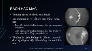 RÁCH HẮC MẠC
• Thường bị che khuất do xuất huyết
• Khi máu tiêu đi => vết sẹo màu trắng, bờ rõ
nét.
• Trực tiếp: tại vị trí chấn thương, khu trú, song song
ora serrata.
• Gián tiếp: xa vị trí chấn thương, một hay nhiều vết
rách, hình liềm, đồng tâm với đĩa thị.
• Thường ổn định, không cần điều trị, theo dõi
định kỳ để phát hiện biến chứng tân mạch hắc
mạc.
ThS.BS. Trần Đình Minh Huy - Bộ môn Mắt Đại Học Y Dược TP.HCM 49
 