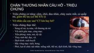 CHẤN THƯƠNG NHÃN CẦU HỞ - TRIỆU
CHỨNG
• Triệu chứng cơ năng: cộm, chói, đau nhức, chảy nước mắt, co quắp
mi, giảm thị lực (có thể ST(-))
• Vỡ nhãn cầu cực sau? CT kín hay hở?
• Triệu chứng thực thể:
• Sưng nề mi, tụ máu, vết thương da mi.
• Vết rách giác mạc, củng mạc.
• Tiền phòng: máu, mủ, dị vật.
• Thủy tinh thể: đục, vỡ.
• Dịch kính: xuất huyết
• Hắc võng mạc: rách, bong.
• Phòi, kẹt tổ chức nội nhãn: mống mắt, thể mi, dịch kính, hắc võng mạc.
ThS.BS. Trần Đình Minh Huy - Bộ môn Mắt Đại Học Y Dược TP.HCM 59
 