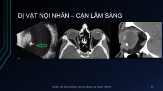 DỊ VẬT NỘI NHÃN – CẬN LÂM SÀNG
ThS.BS. Trần Đình Minh Huy - Bộ môn Mắt Đại Học Y Dược TP.HCM 69
 