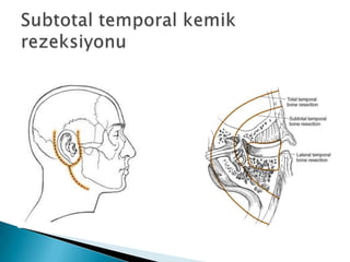 Head and Neck Surgery Incisions Dr. Cavid Cabbarzade Hacettepe ENT | PPTX