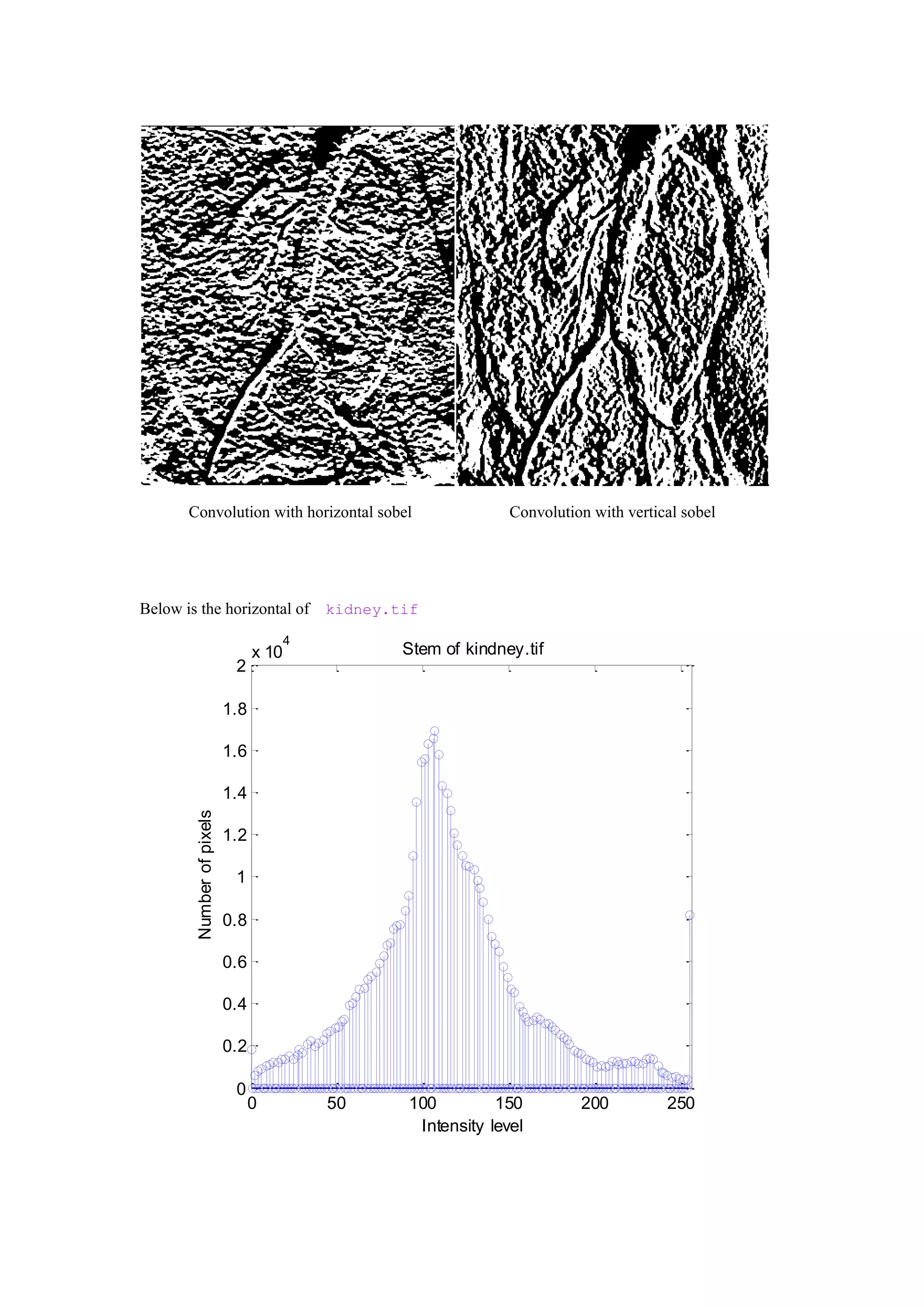 Convolution with horizontal sobel Convolution with vertical sobel
Below is the horizontal of kidney.tif
0 50 100 150 200 250
0
0.2
0.4
0.6
0.8
1
1.2
1.4
1.6
1.8
2
x 10
4
Stem of kindney.tif
Intensity level
Numberofpixels
 