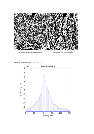 Convolution with horizontal sobel Convolution with vertical sobel
Below is the horizontal of kidney.tif
0 50 100 150 200 250
0
0.2
0.4
0.6
0.8
1
1.2
1.4
1.6
1.8
2
x 10
4
Stem of kindney.tif
Intensity level
Numberofpixels
