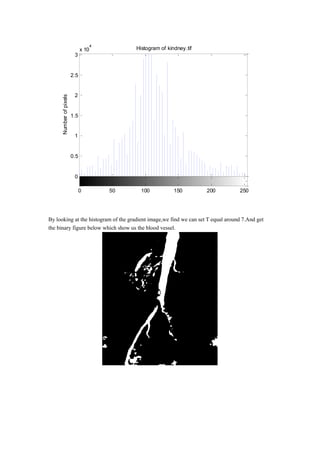 By looking at the histogram of the gradient image,we find we can set T equal around 7.And get
the binary figure below which show us the blood vessel.
0
0.5
1
1.5
2
2.5
3
x 10
4
Histogram of kindney.tif
Intensity level
Numberofpixels
0 50 100 150 200 250