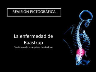 La enfermedad de
Baastrup
Síndrome de las espinas besándose
REVISIÓN PICTOGRÁFICA
 