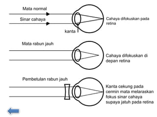 Mata normal

Sinar cahaya                Cahaya difokuskan pada
                            retina

                    kanta

Mata rabun jauh

                            Cahaya difokuskan di
                            depan retina



 Pembetulan rabun jauh
                            Kanta cekung pada
                            cermin mata melaraskan
                            fokus sinar cahaya
                            supaya jatuh pada retina
 