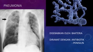 PNEUMONIA
DISEBABKAN OLEH: BAKTERIA
DIRAWAT DENGAN: ANTIBIOTIK
- PENISILIN
 