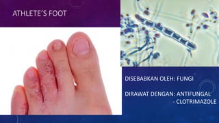 ATHLETE’S FOOT
DISEBABKAN OLEH: FUNGI
DIRAWAT DENGAN: ANTIFUNGAL
- CLOTRIMAZOLE
 