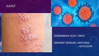 KAYAP
DISEBABKAN OLEH: VIRUS
DIRAWAT DENGAN: ANTIVIRAL
- ACYCLOVIR
 
