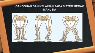 GANGGUAN DAN KELAINAN PADA SISTEM GERAK
MANUSIA
 