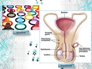 Kondom
Vasektomi
 