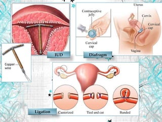 IUD Diafragm
Ligation
 