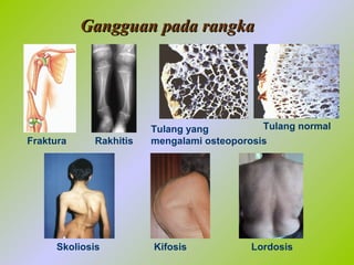 Kaki Rakhitis Bab 4 sistem gerak | PPT