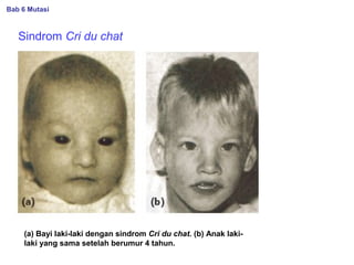 Sindrom Cri du chat
(a) Bayi laki-laki dengan sindrom Cri du chat. (b) Anak laki-
laki yang sama setelah berumur 4 tahun.
Bab 6 Mutasi
 